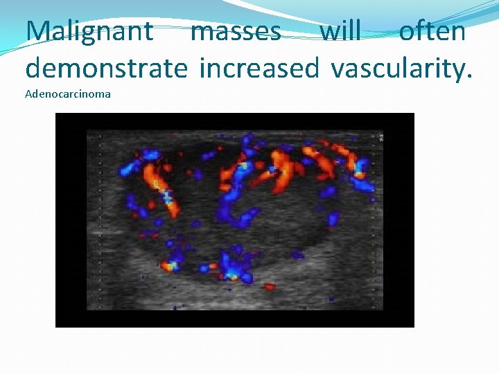 Malignant masses will often demonstrate increased vascularity. Adenocarcinoma 