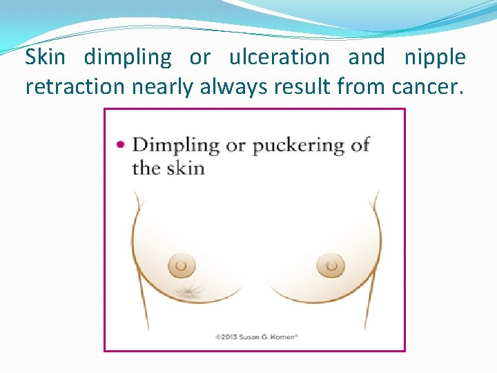 Skin dimpling or ulceration and nipple retraction nearly always result from cancer. 