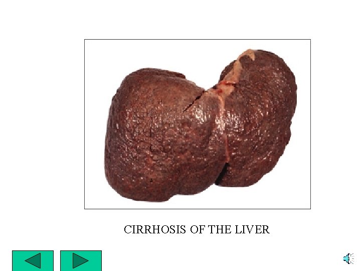 CIRRHOSIS OF THE LIVER 