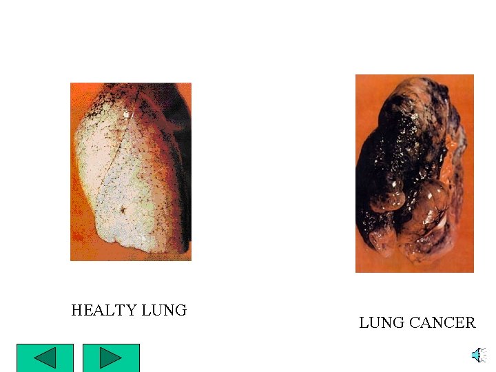 HEALTY LUNG CANCER 