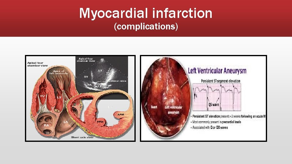 Complications of myocardial infarction PRESENTED BY AHMAD ALDOGHMI