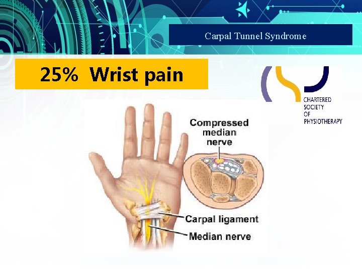 Carpal Tunnel Syndrome 25% Wrist pain 