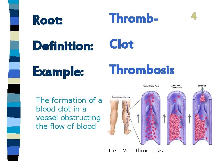 Root: Thromb- Definition: Clot Example: Thrombosis The formation of a blood clot in a