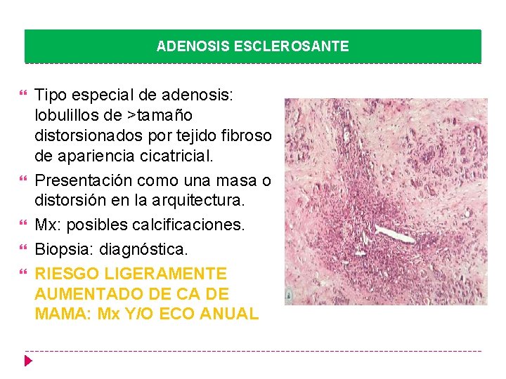 ADENOSIS ESCLEROSANTE Tipo especial de adenosis: lobulillos de >tamaño distorsionados por tejido fibroso de