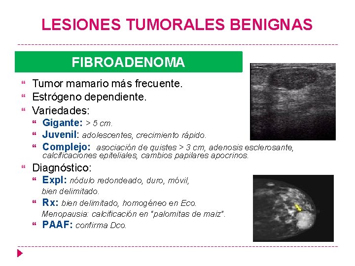 LESIONES TUMORALES BENIGNAS FIBROADENOMA Tumor mamario más frecuente. Estrógeno dependiente. Variedades: Gigante: > 5