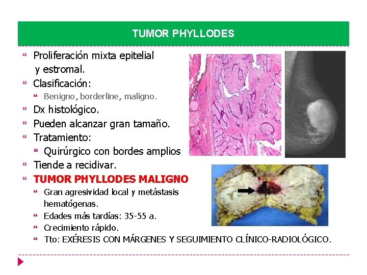 TUMOR PHYLLODES Proliferación mixta epitelial y estromal. Clasificación: Benigno, borderline, maligno. Dx histológico. Pueden