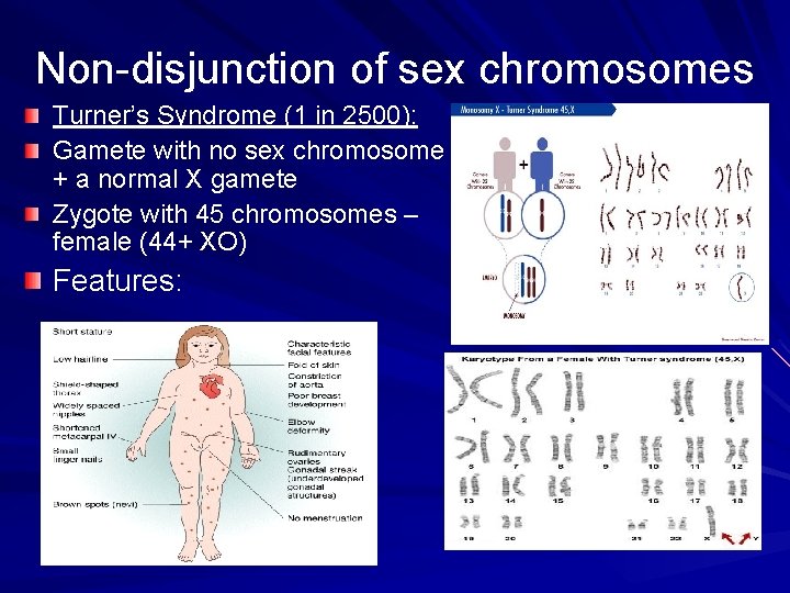 Non-disjunction of sex chromosomes Turner’s Syndrome (1 in 2500): Gamete with no sex chromosome