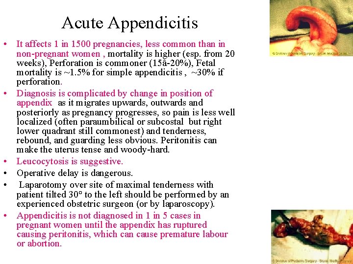 Acute Appendicitis • It affects 1 in 1500 pregnancies, less common than in non-pregnant