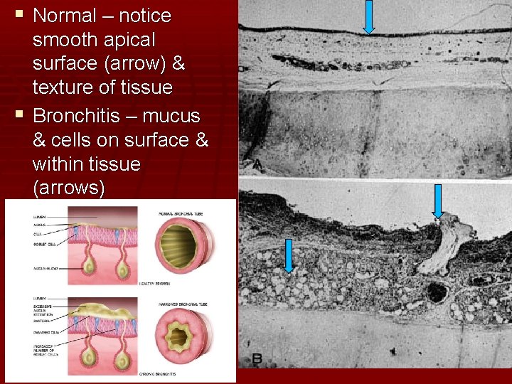  Normal – notice smooth apical surface (arrow) & texture of tissue Bronchitis –