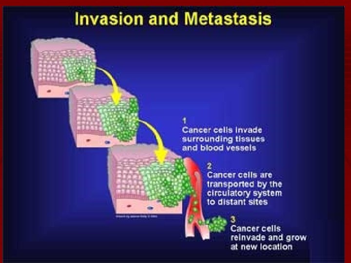 Metastasis 