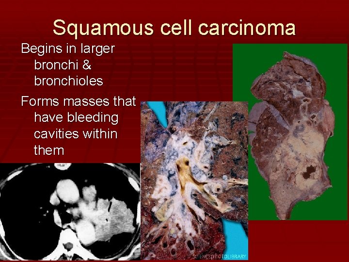 Squamous cell carcinoma Begins in larger bronchi & bronchioles Forms masses that have bleeding