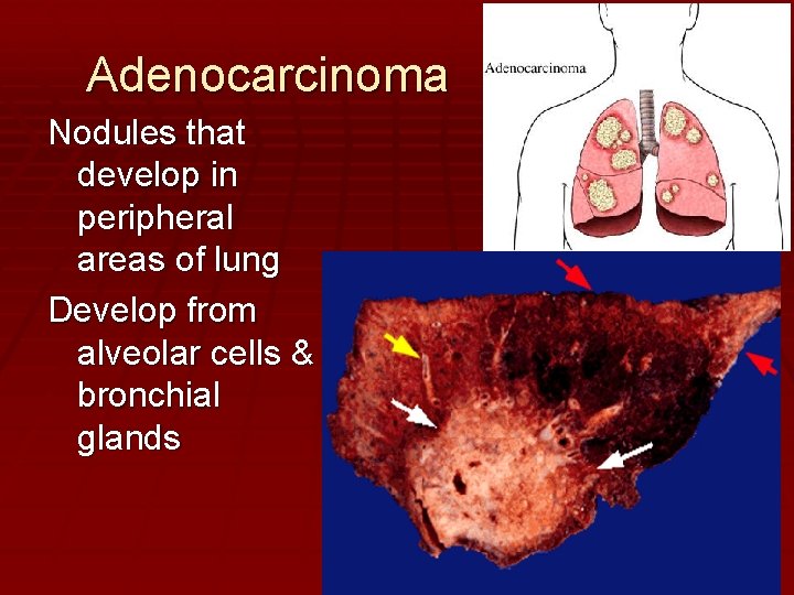 Adenocarcinoma Nodules that develop in peripheral areas of lung Develop from alveolar cells &