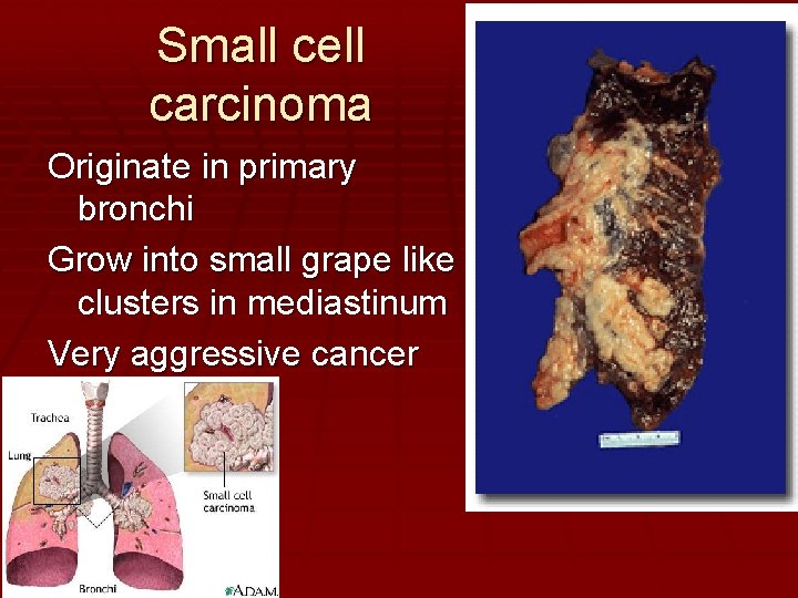 Small cell carcinoma Originate in primary bronchi Grow into small grape like clusters in