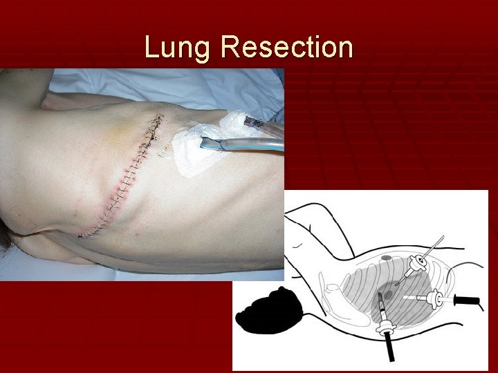 Lung Resection 