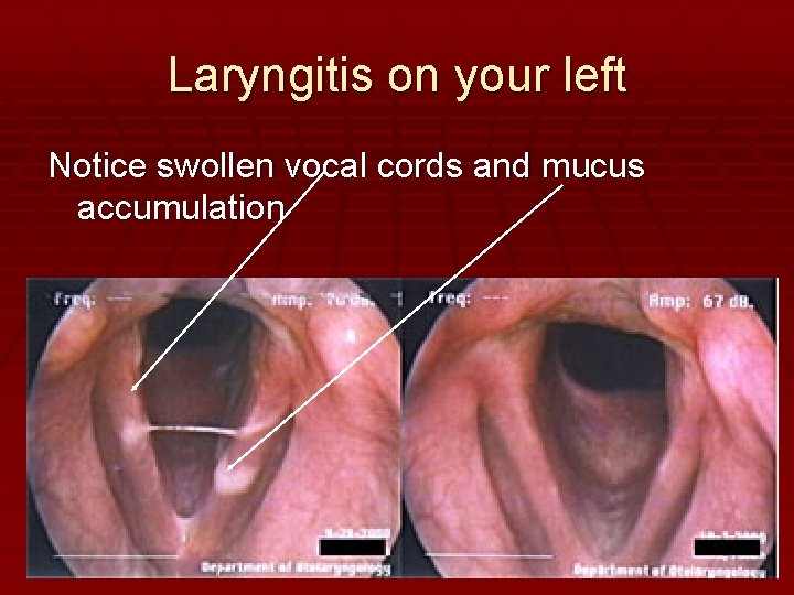 Laryngitis on your left Notice swollen vocal cords and mucus accumulation 