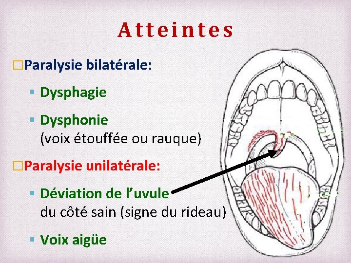 Atteintes �Paralysie bilatérale: Dysphagie Dysphonie (voix étouffée ou rauque) �Paralysie unilatérale: Déviation de l’uvule