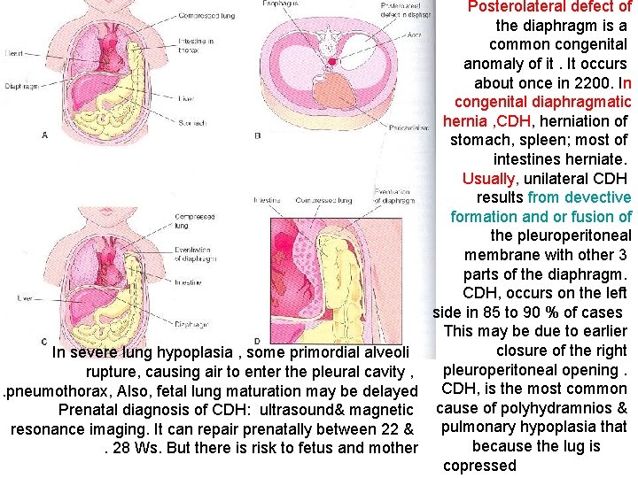 Posterolateral defect of the diaphragm is a common congenital anomaly of it. It occurs