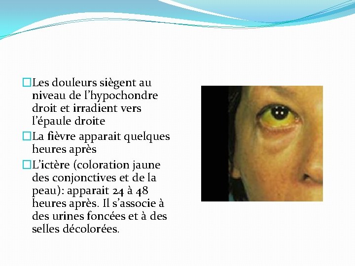 �Les douleurs siègent au niveau de l’hypochondre droit et irradient vers l’épaule droite �La