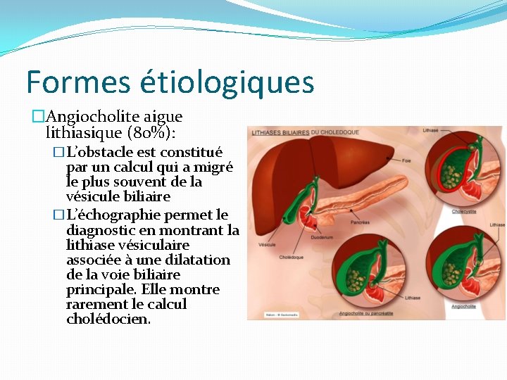 Formes étiologiques �Angiocholite aigue lithiasique (80%): �L’obstacle est constitué par un calcul qui a