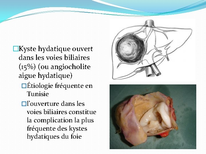 �Kyste hydatique ouvert dans les voies biliaires (15%) (ou angiocholite aigue hydatique) �Étiologie fréquente