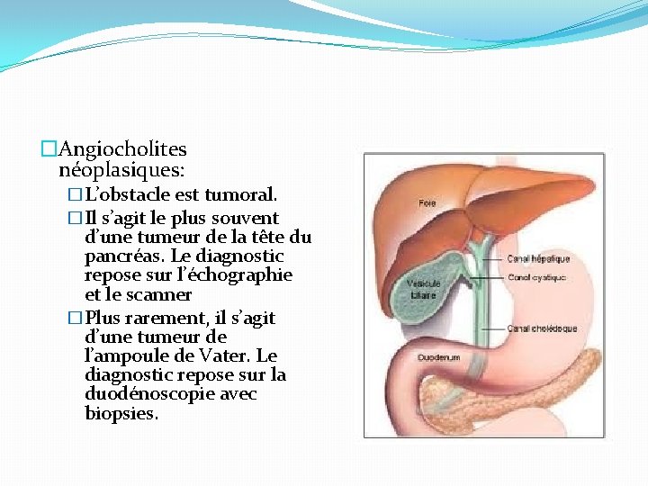 �Angiocholites néoplasiques: �L’obstacle est tumoral. �Il s’agit le plus souvent d’une tumeur de la