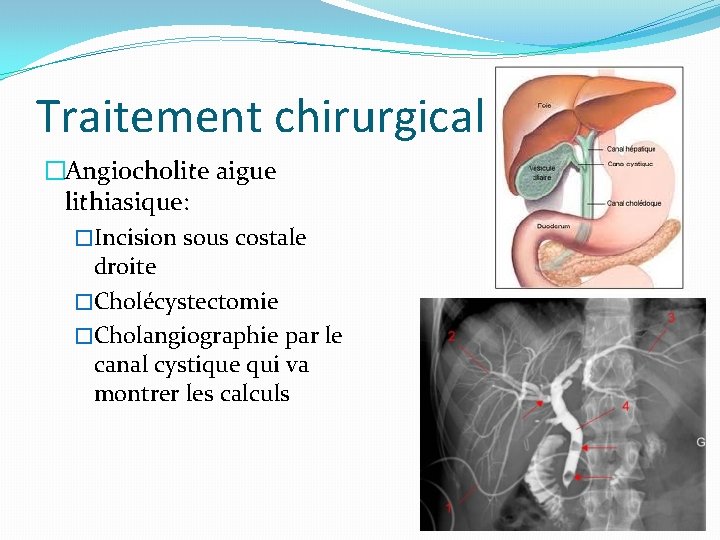 Traitement chirurgical �Angiocholite aigue lithiasique: �Incision sous costale droite �Cholécystectomie �Cholangiographie par le canal
