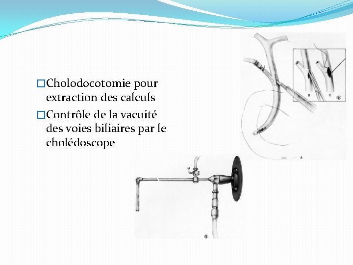 �Cholodocotomie pour extraction des calculs �Contrôle de la vacuité des voies biliaires par le