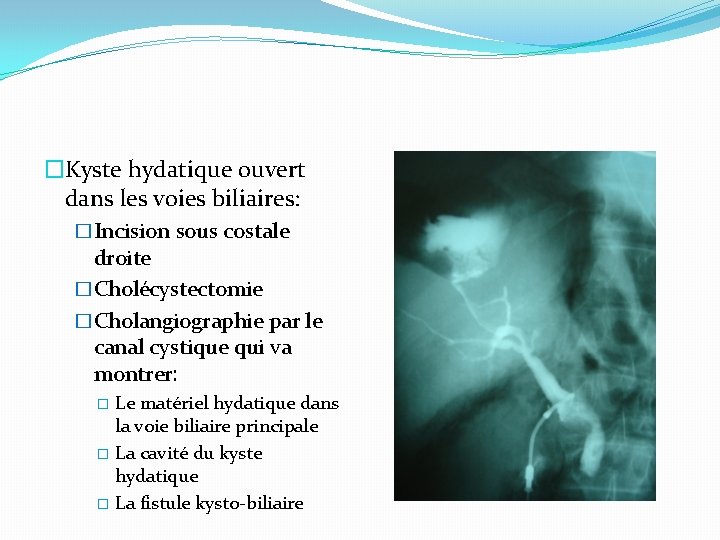 �Kyste hydatique ouvert dans les voies biliaires: �Incision sous costale droite �Cholécystectomie �Cholangiographie par