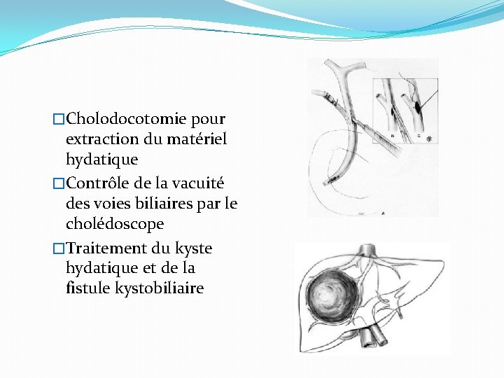 �Cholodocotomie pour extraction du matériel hydatique �Contrôle de la vacuité des voies biliaires par