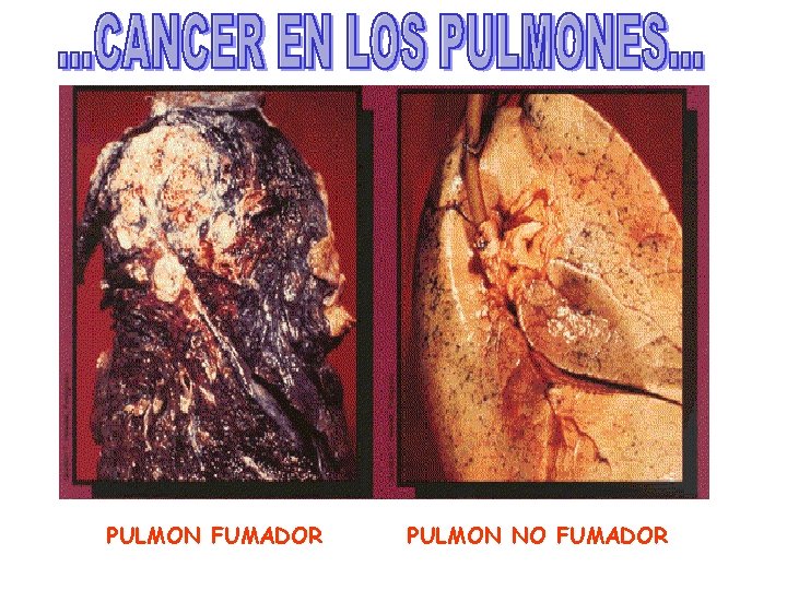 PULMON FUMADOR PULMON NO FUMADOR 