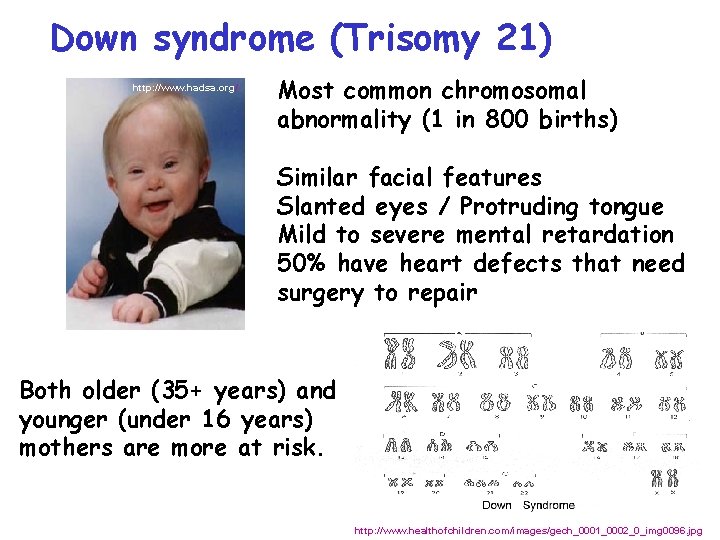 Down syndrome (Trisomy 21) http: //www. hadsa. org/ Most common chromosomal abnormality (1 in