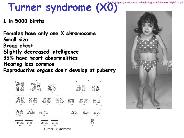 Turner syndrome (X 0) http: //medgen. genetics. utah. edu/photographs/diseases/high/611. gif 1 in 5000 births
