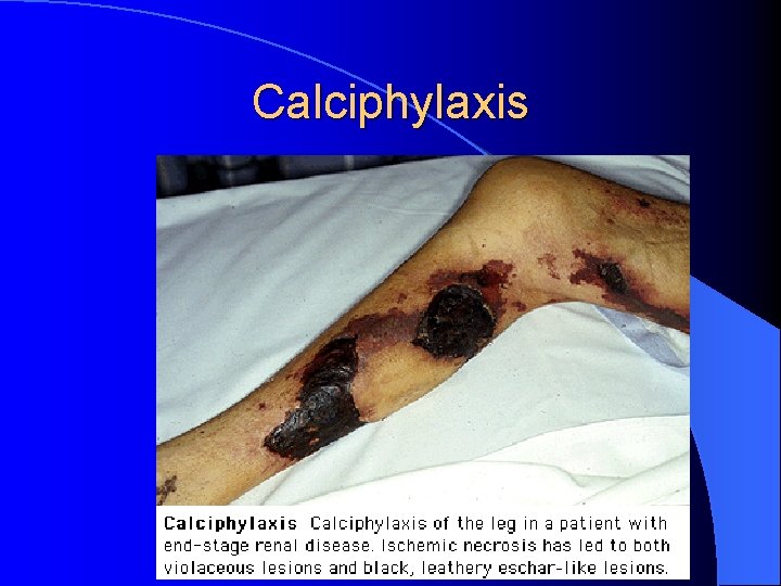 Calciphylaxis 