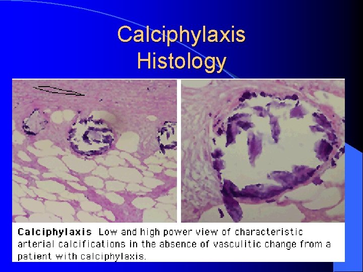 Calciphylaxis Histology 