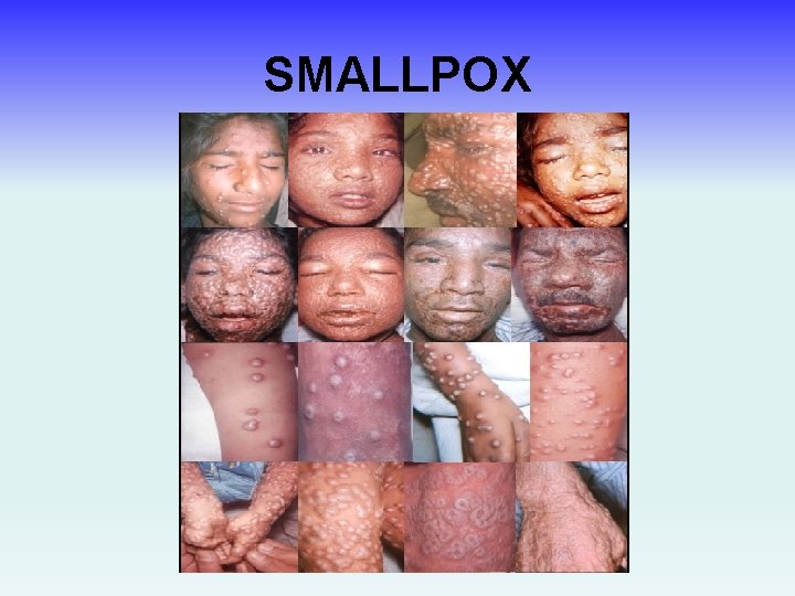 SMALLPOX 