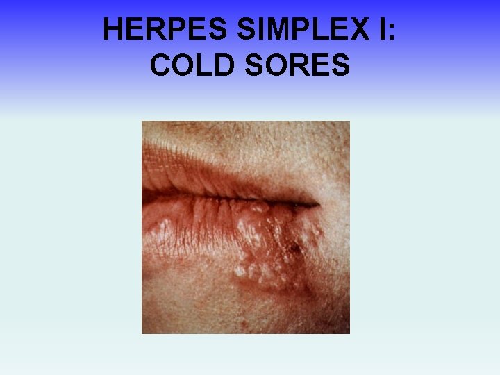 HERPES SIMPLEX I: COLD SORES 