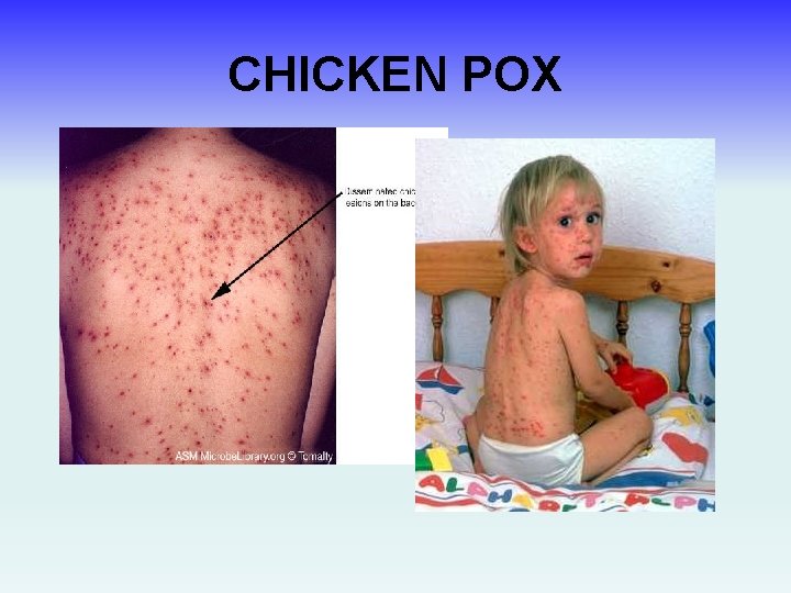 CHICKEN POX 
