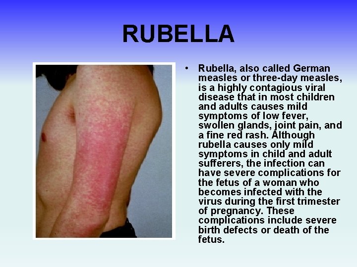 RUBELLA • Rubella, also called German measles or three-day measles, is a highly contagious