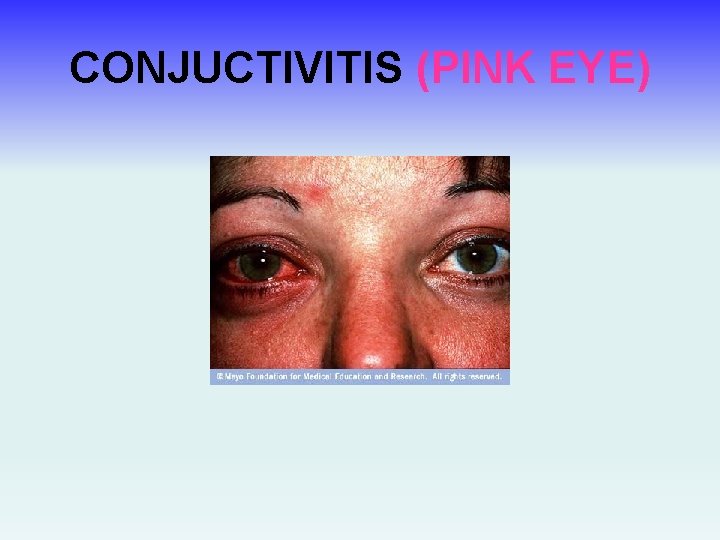 CONJUCTIVITIS (PINK EYE) 