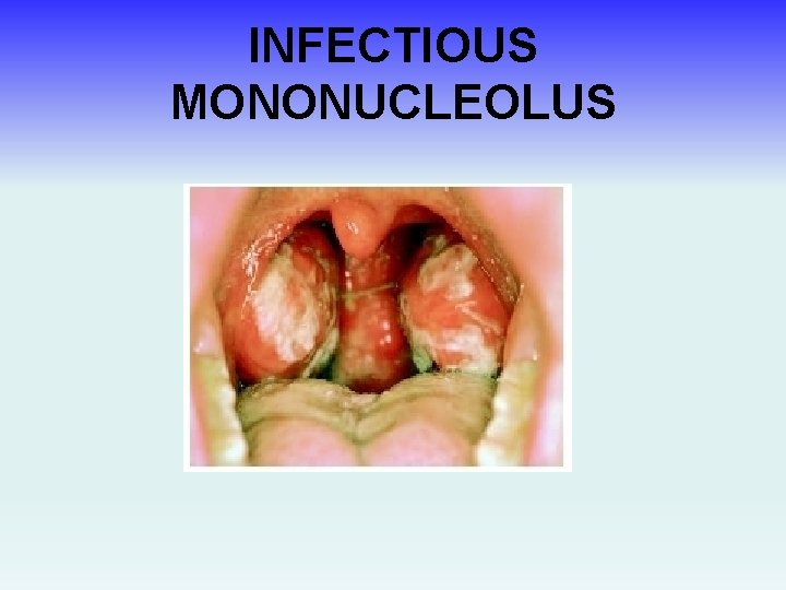INFECTIOUS MONONUCLEOLUS 
