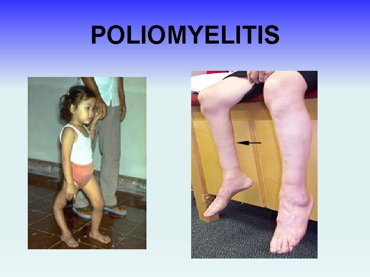 POLIOMYELITIS 