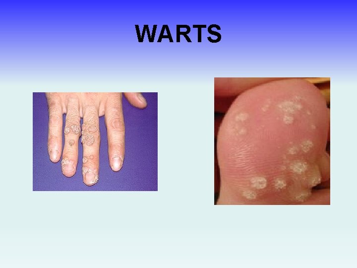 WARTS 