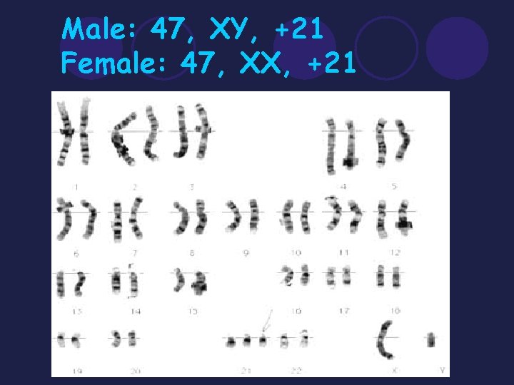 Male: 47, XY, +21 Female: 47, XX, +21 