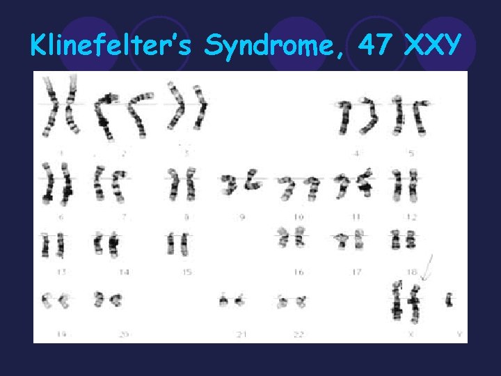 Klinefelter’s Syndrome, 47 XXY 