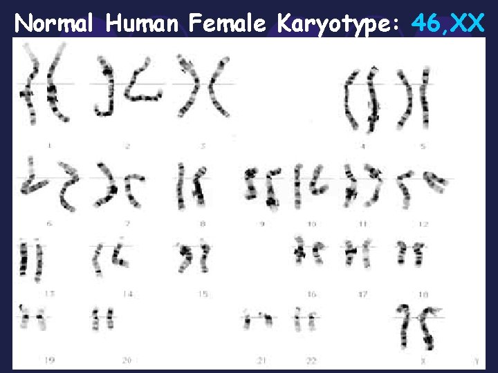 Normal Human Female Karyotype: 46, XX 