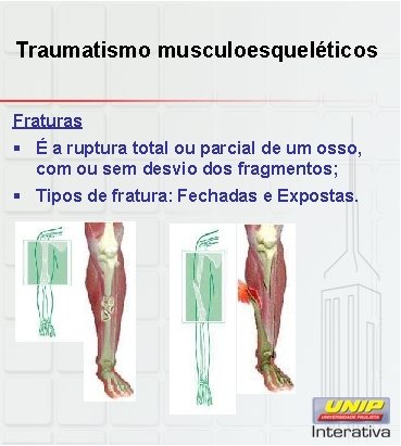 Traumatismo musculoesqueléticos Fraturas § É a ruptura total ou parcial de um osso, com