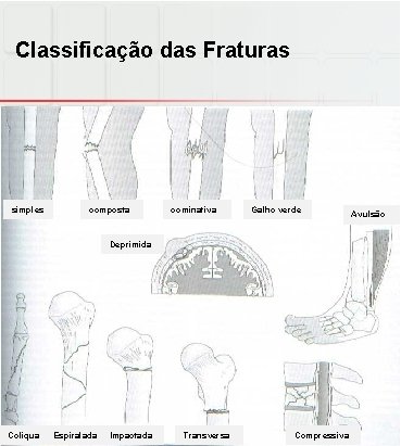 Classificação das Fraturas simples composta cominativa Galho verde Deprimida Coliqua Espiralada Impactada Transversa Compressiva