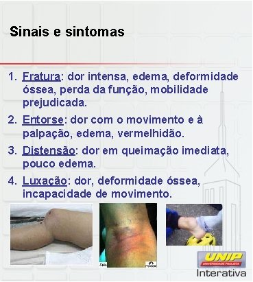 Sinais e sintomas 1. Fratura: dor intensa, edema, deformidade óssea, perda da função, mobilidade