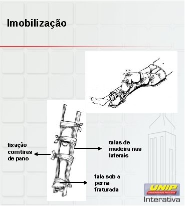 Imobilização fixação com tiras de pano talas de madeira nas laterais tala sob a