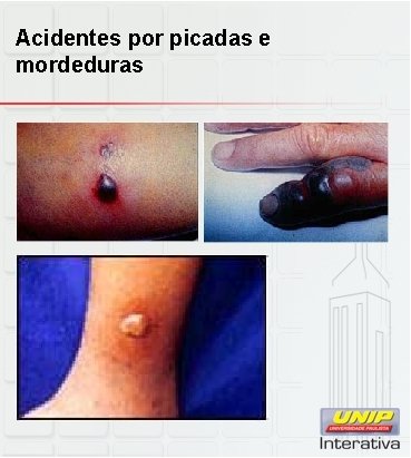 Acidentes por picadas e mordeduras 